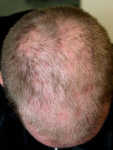 Rụng tóc do lupus có thể rụng từng mảng hoặc lan tỏa toàn bộ đầu