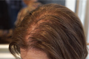 Rụng tóc rừng thưa ở thời kỳ mãn kinh của phụ nữ