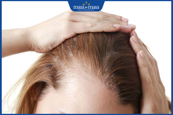rụng tóc thời kỳ mãn kinh