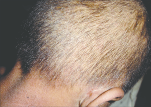 Tóc rụng đồng đều trên toàn bộ đầu do rối loạn tuyến giáp
