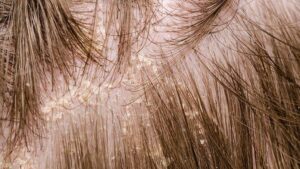 Tình trạng viêm da nhẹ trên da đầu có thể khỏi nhờ dầu gội đặc trị