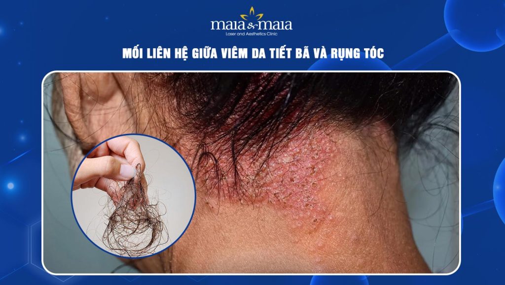 Mối liên hệ giữa viêm da tiết bã và rụng tóc 1 viêm da tiết bã gây rụng tóc