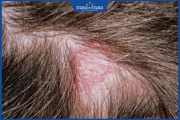 viêm da tiết bã rụng tóc