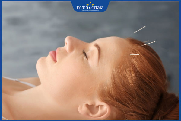 châm cứu