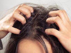 Da đầu sạch sẽ có thể giảm bớt tình trạng ngứa ngáy