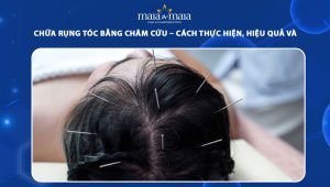 chữa rụng tóc bằng châm cứu