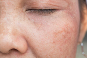 Làn da có thể bị mẩn đỏ nếu dùng thuốc liều lượng không đúng