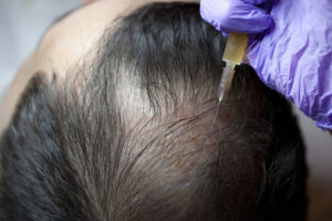 Huyết tương giàu tiểu cầu được đưa tiêm trực tiếp vào vùng rụng tóc
