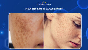 nám da và tăng sắc tố