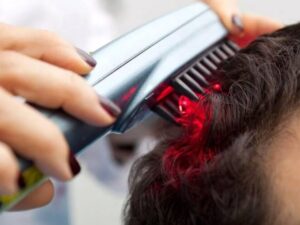 Điều trị rụng tóc bằng phương pháp laser cường độ thấp