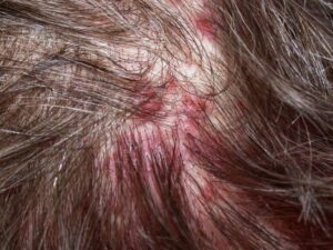 Mẩn đỏ trên da đầu là một biểu hiện thường thấy của rụng tóc do lực kéo