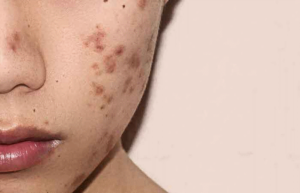Mụn chứng các cũng có thể gây nên chứng tăng sắc tố da