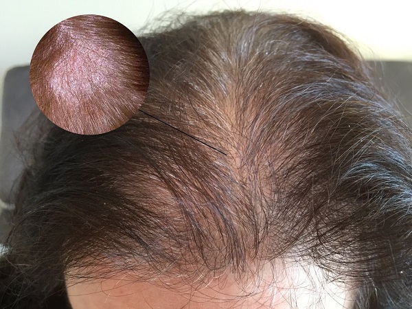 Nấm đầu là một bệnh da đầu phổ biến và là một trong những nguyên nhân gây rụng tóc