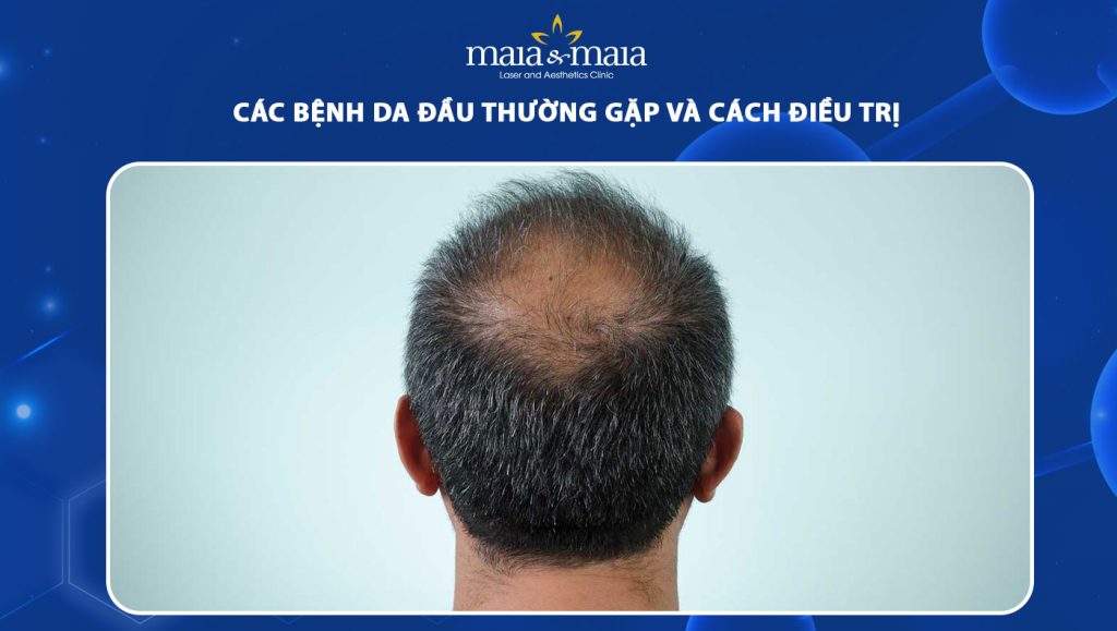 các bệnh da đầu thường gặp và cách điều trị