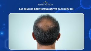 các bệnh da đầu thường gặp và cách điều trị
