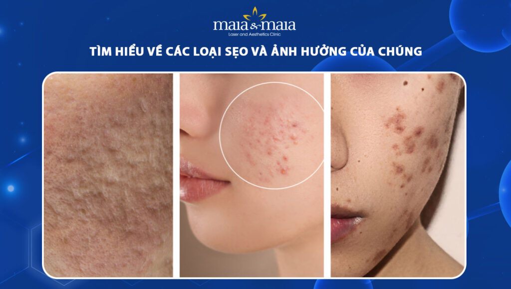 Tìm hiểu về các loại sẹo và ảnh hưởng của chúng 1 các loại sẹo