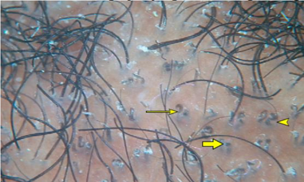 Tóc bị cuộn xoắn trên da đầu do ảnh hưởng của bệnh nấm đầu