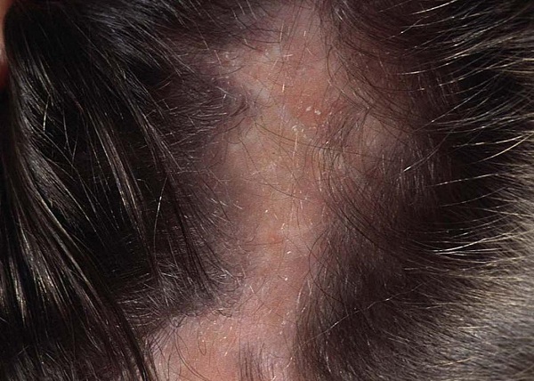Rụng tóc nghiêm trọng khi bị nấm da đầu