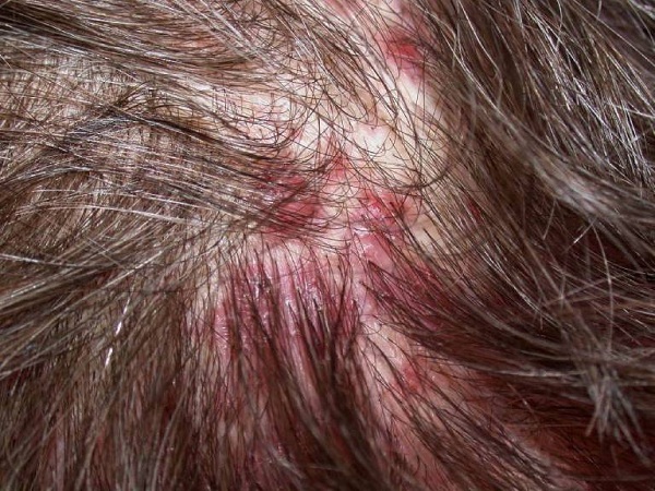 Các đám mụn nhỏ là biểu hiện cơ bản của viêm nang lông da đầu