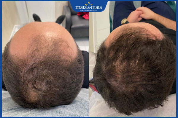 kết quả trị rụng tóc bằng laser