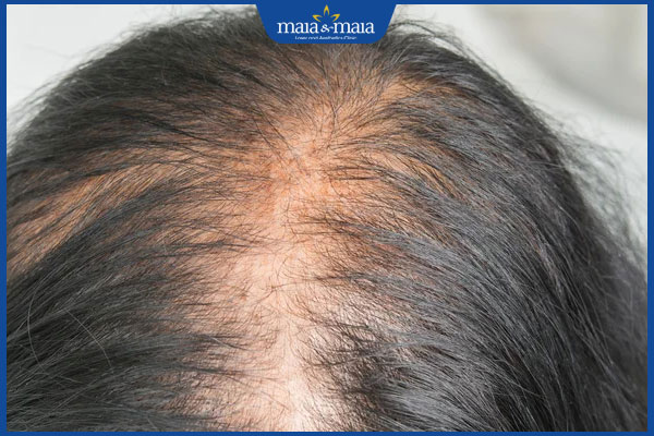 Rụng tóc thời kỳ mãn kinh do đâu? Bí quyết ngừa rụng tóc 2 mãn kinh rụng tóc