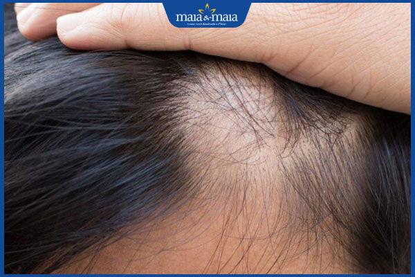 rụng tóc để lại sẹo