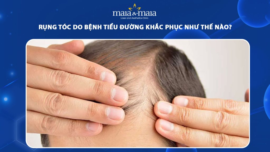 Rụng tóc do bệnh tiểu đường khắc phục như thế nào? 1 rụng tóc do bệnh tiểu đường khắc phục như thế nào