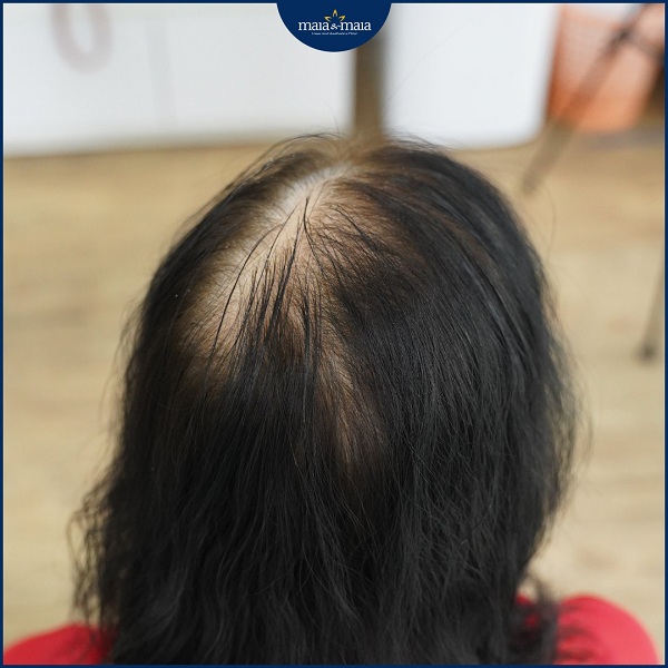 Chứng rụng tóc do mãn kinh làm thưa hói tóc ở vùng đỉnh đầu