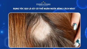 rụng tóc sẹo