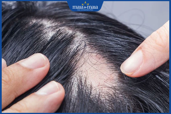 rụng tóc thể mảng của Brocq