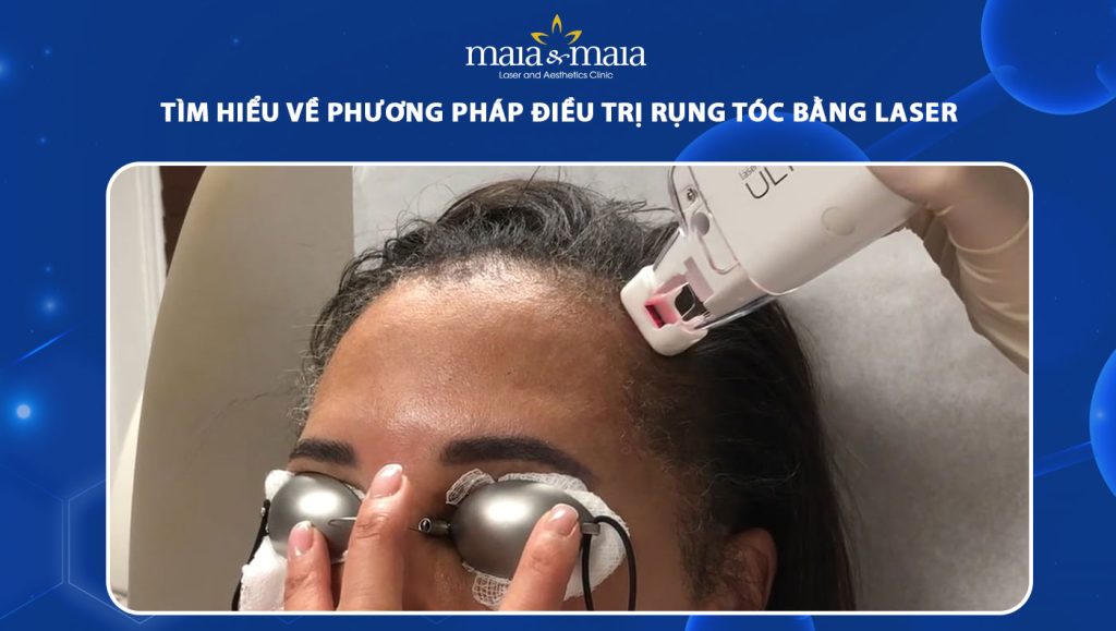 tìm hiểu về phương pháp điều trị rụng tóc bằng laser