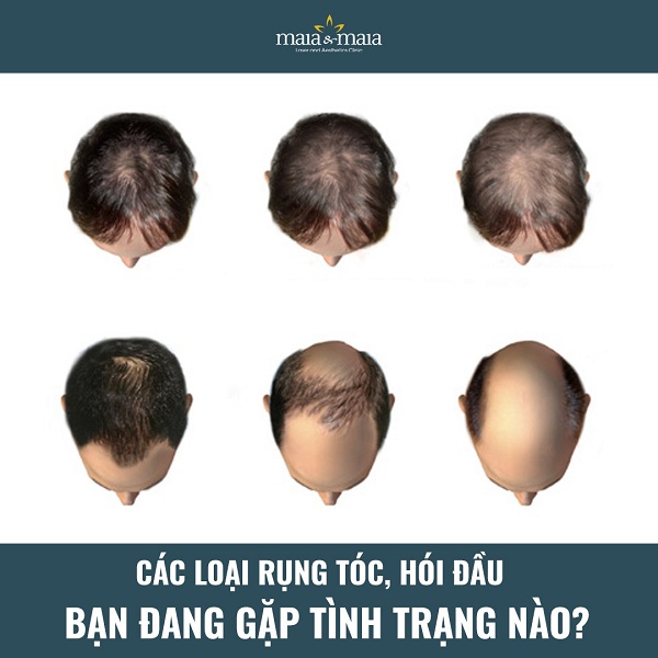 6 nguyên nhân gây nên tình trạng tóc dầu và cách khắc phục  BlogAnChoi