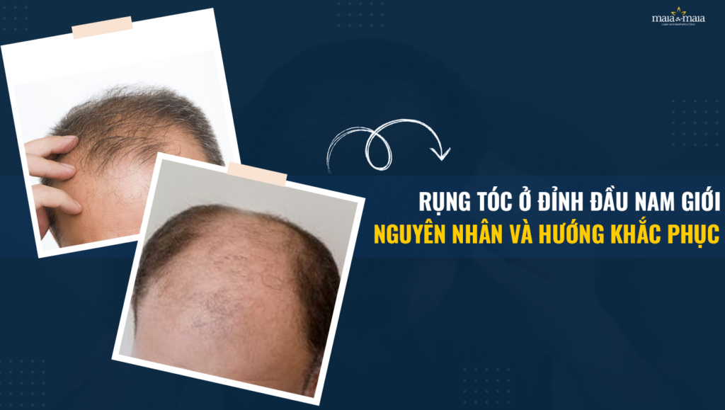 Nguyên nhân nào dẫn đến rụng tóc đỉnh đầu ở cả nam và nữ