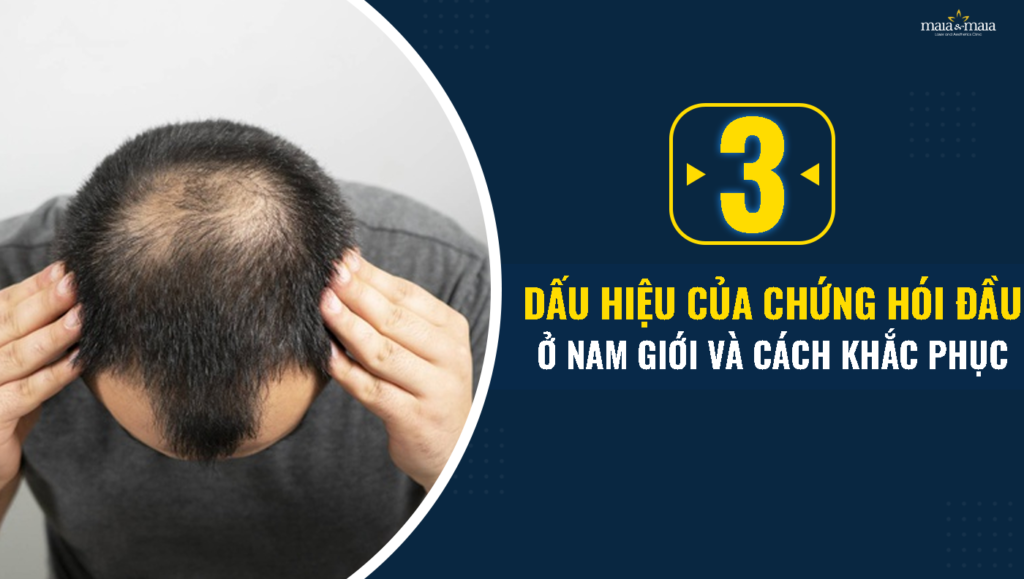 3 Dấu hiệu của chứng hói đầu ở nam giới và cách khắc phục