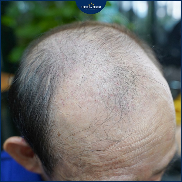 Chức năng của nang tóc không được phát huy trong trường hợp rụng tóc hói đầu do di truyền