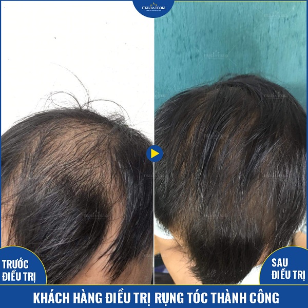 Hiệu quả khi sử dụng phương pháp Meso hỗ trợ kích thích mọc tóc 