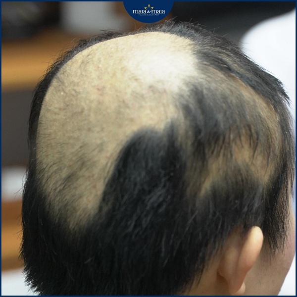 Rụng tóc do nấm đầu sẽ mọc tóc trở lại sau khi điều trị khỏi bệnh