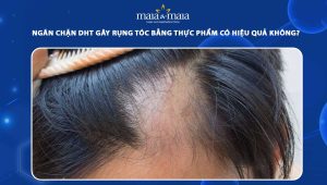 ngăn chặn dht gây rụng tóc bằng thực phẩm