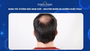 nguyên nhân rụng tóc ở đỉnh đầu nam giới