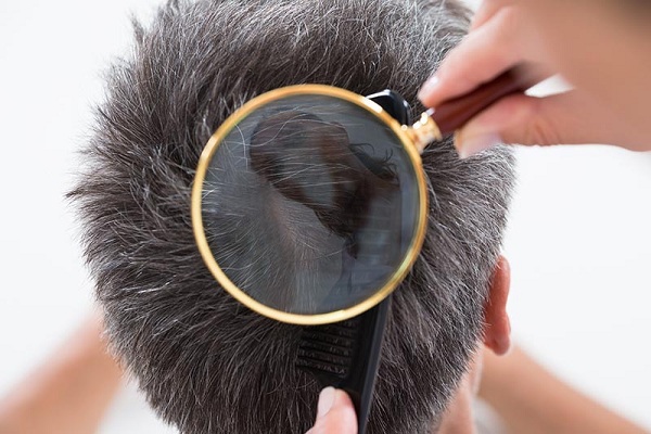 Gợi ý 7 kiểu tóc cho người hói đỉnh đầu không bao giờ sợ lỗi mốt