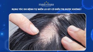 rụng tóc do bệnh tự miễn là gì