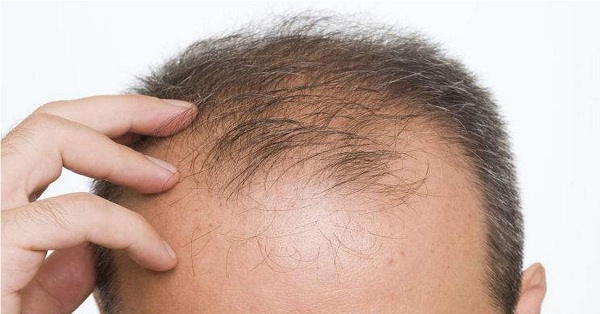 Hút thuốc lá có thể kích phát quá trình rụng tóc hói đầu ở nam giới