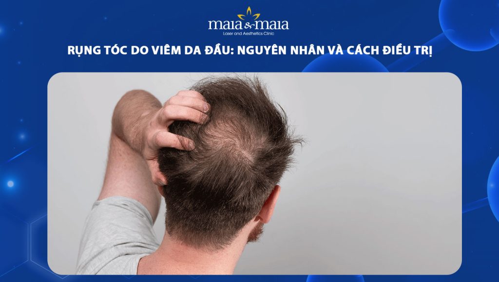 rụng tóc do viêm da đầu
