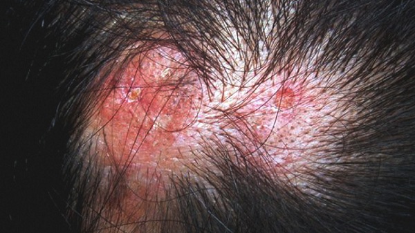 Rụng tóc sẹo do lupus ban đỏ dạng đĩa
