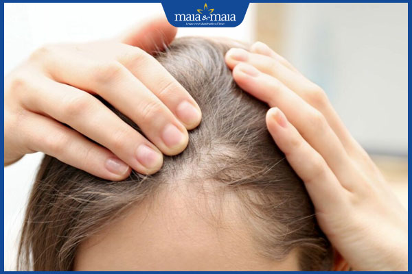 Rụng tóc do bệnh tự miễn là gì? Có điều trị được không? 2 tình trạng rụng tóc tự miễn