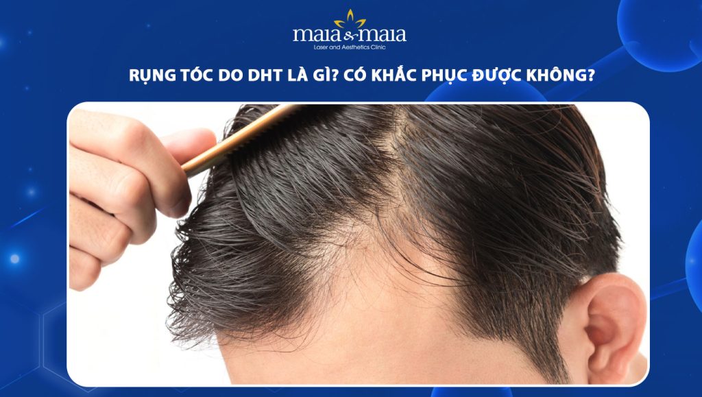 Rụng tóc do DHT là gì? Có khắc phục được không? 1 rụng tóc do DHT