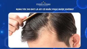 rụng tóc do DHT