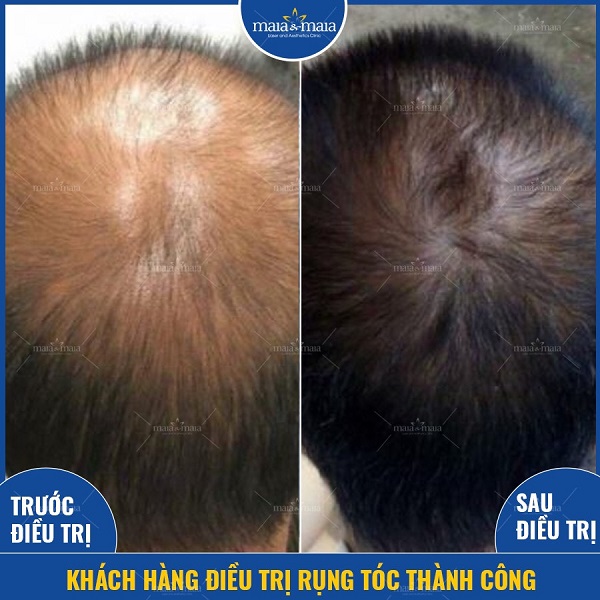 Điều trị rụng tóc bằng phương pháp cung cấp dưỡng chất tại phòng khám Maia