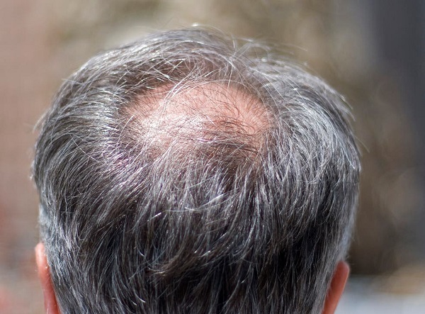 Rụng tóc ở phần đỉnh đầu của nam giới do ảnh hưởng của DHT