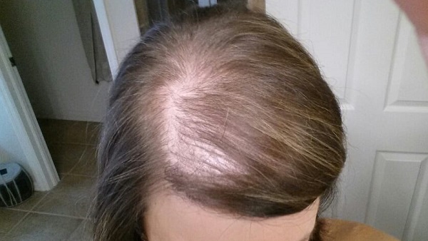 Tại sao rối loạn nội tiết gây nên tình trạng rụng tóc  Vinmec